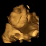 Una imagen de escaneo 4D del mismo feto que muestra una reacción de cara de llanto después de haber estado expuesto al sabor de la col rizada.