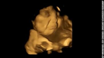 Una imagen de escaneo 4D del mismo feto que muestra una reacción de cara de llanto después de haber estado expuesto al sabor de la col rizada.