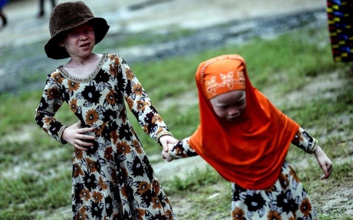 Las mujeres con albinismo tienen 3 veces más probabilidades de ser víctimas de violencia de género, sugiere sociedad de albinismo
