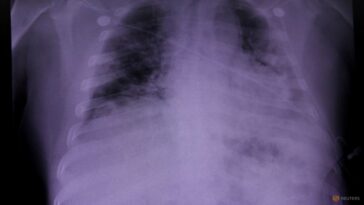 Las evaluaciones pulmonares racialmente neutrales en EE. UU. tendrán efectos profundos, según un estudio