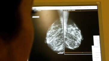 Nuevos genes de cáncer de mama encontrados en mujeres de ascendencia africana pueden mejorar la evaluación de riesgos